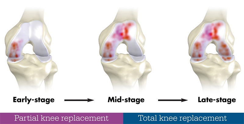 Knee CT Scan