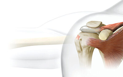 Innovative Treatment for Rotator Cuff Pain